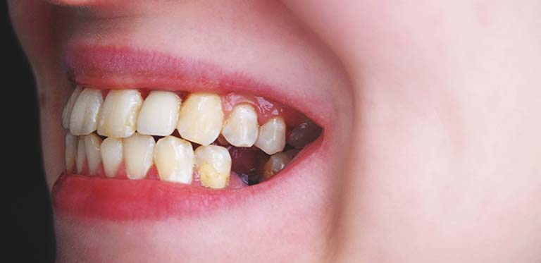 Bạn nên làm gì khi bị mất răng?
