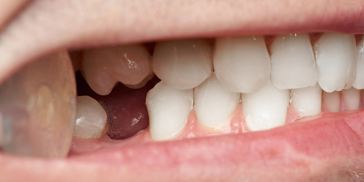 Nguyên nhân gây mất răng là gì?
